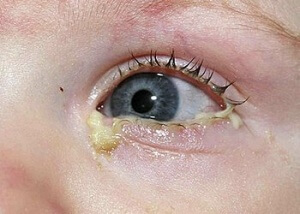 Вирусный и бактериальный конъюнктивит, как правило, характеризуется обильными гнойными выделениями из глаз