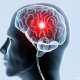 Склероз сосудов головного мозга: признаки болезни, причины, диагностика и лечение