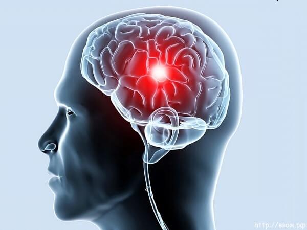 Склероз сосудов головного мозга: признаки болезни, причины, диагностика и лечение