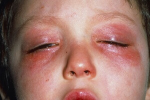 Покраснение кожных покровов и слезотечение, также может свидетельствовать о холодовом дерматите