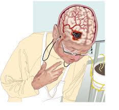 Инсульт - острое нарушение мозгового кровообращения