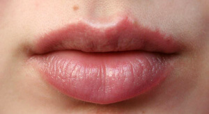 При появлении на губах симптомов аллергии следует обратиться к специалисту