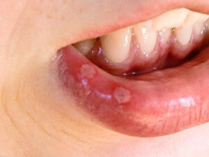 Одна из причин возникновения стоматита - несоблюдение гигиены полости рта