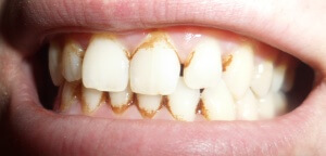 Курение - причина возникновения зубного камня