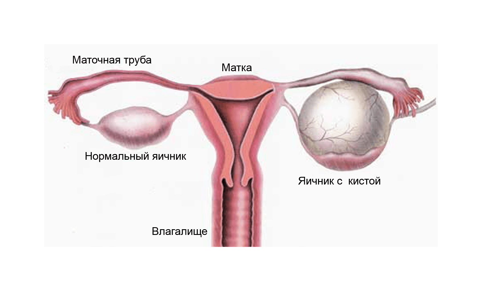 Жидкость в яичниках у женщин: причины, способы лечения