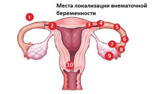 Внематочную беременность на первой стадии определить сложно