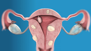 Для лечения фибромы матки применяют, как консервативное так и хирургическое лечение