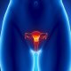 Фиброма матки: симптомы и лечение недуга