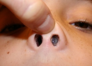 Слизистая оболочка носа чаще всго поражается золотистым стафилококком