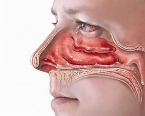Вазотомия носовых раковин: показания и особенности процедуры