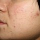 Что означают прыщи на лице: кожная сыпь, как признак заболевания