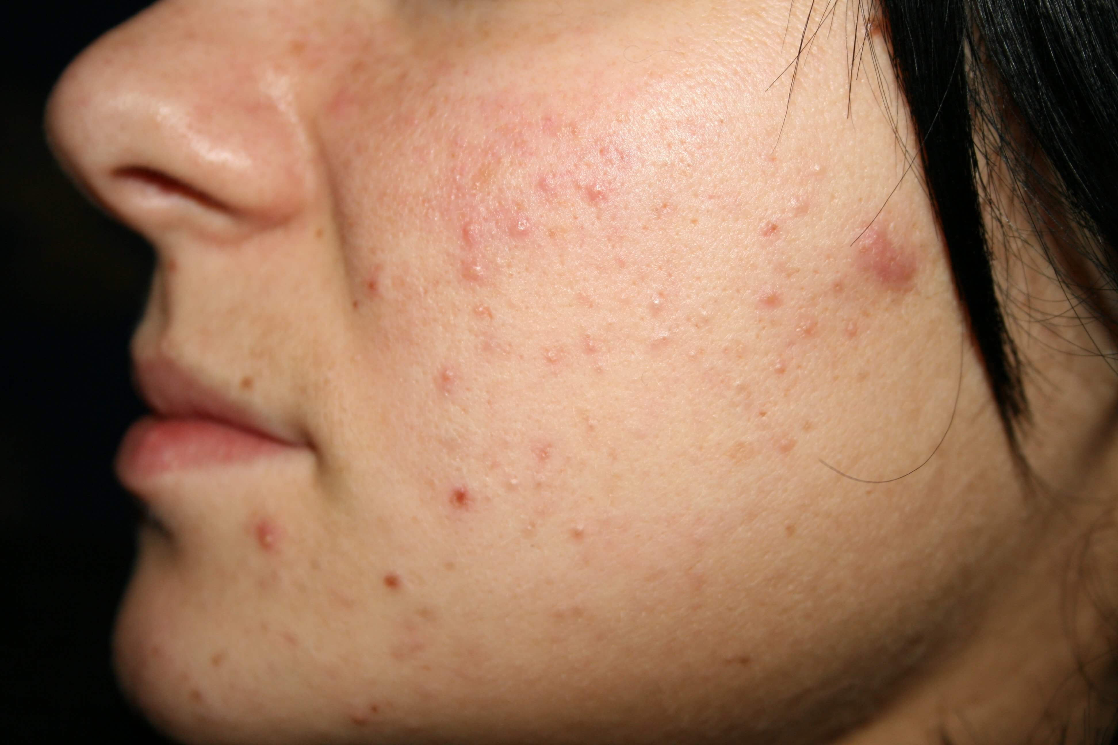 Что означают прыщи на лице: кожная сыпь, как признак заболевания