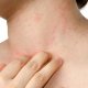 Аллергия на шее: в чем причина