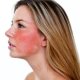 Как быстро снять покраснение на лице: эффективные способы