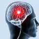 Ишемия мозга: симптомы недуга