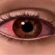 Ожог роговицы глаза: причины, симптомы, лечение