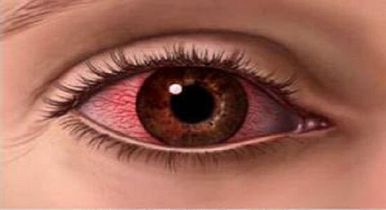 Ожог роговицы глаза: причины, симптомы, лечение