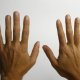 Болят фаланги пальцев рук: причина и лечение патологического состояния