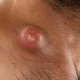 Как лечить воспаленные лимфоузлы на шее: причины патологии и методы лечения