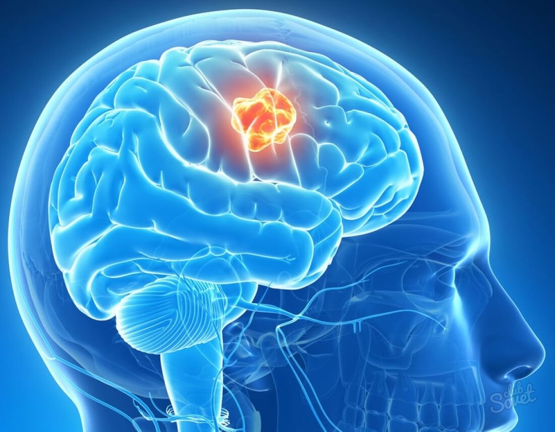 Инсульт с кровоизлиянием в мозг: последствия и причины болезни