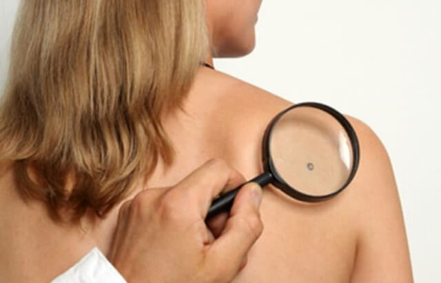 Базально-клеточный рак кожи: лечение и прогноз