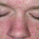 Чем лечить себорейный дерматит на лице: основные рекомендации