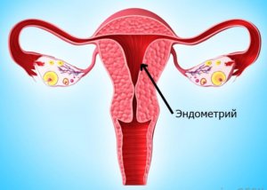 Железистая гиперплазия - разрастание клеток эндометрия на слизистой матки