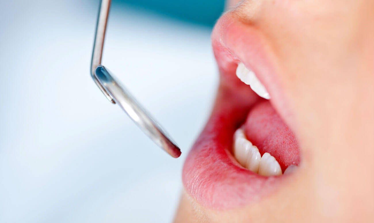 Зубной свищ: причины появления и необходимое лечение
