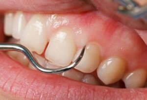 Зубной свищ - результат плохого стоматологического лечения