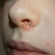 Герпес под носом: лечение патологического состояния