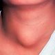 Воспаление щитовидной железы: причины и симптомы