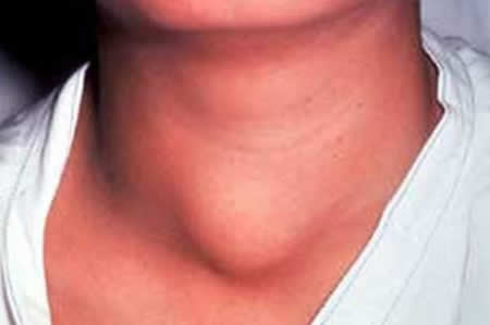 Воспаление щитовидной железы: причины и симптомы