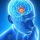 Невринома головного мозга: особенности патологии