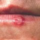 Рак губы: первые признаки опасного недуга