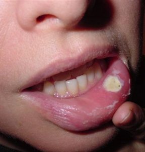 Рак губы - опасный недуг. Будьте бдительны!