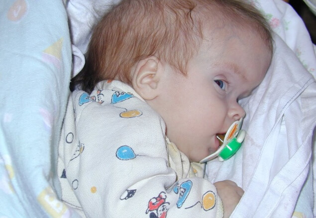 Отек мозга у новорожденного: причины, симптомы, последствия патологии