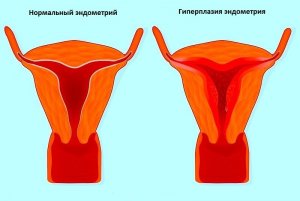 Гиперплазия эндометрия - серьезная патология женского репродуктивного органа