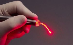 Лазерная имплантация - современный метод потезирования зубов