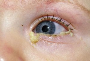 Конъюнктивит - одна из причин нагноения глазок у ребенка