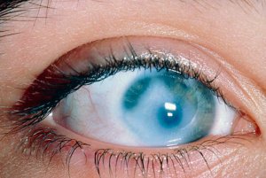 Помутнение роговицы - сербезная глазная патология