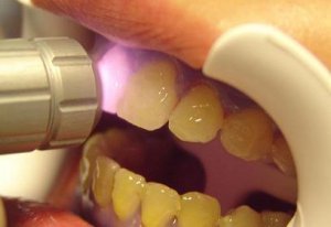 Лазерное отбеливание - эффективная стоматологическая процедура  