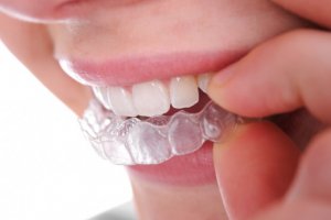 О народных способах отбеливания зубов нужно знать!