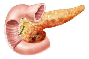 Панкреатит - воспалительная патология поджелудочной железы