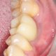 В чем заключается опасность для здоровья, когда десна нарастает на зуб