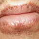 Хейлит на губах: лечение, профилактика и смена привычек