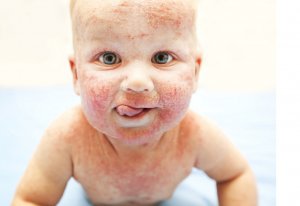 Обращение к врачу по поводу аллергии у ребенка