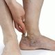 Болезни сосудов ног: терапия и основные рекомендации по профилактике