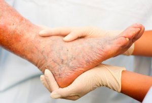 Терапия заболеваний ног