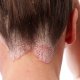 Экзема на голове: лечение дерматологического заболевания