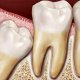 Растет зуб мудрости и болит десна: что делать до похода к стоматологу